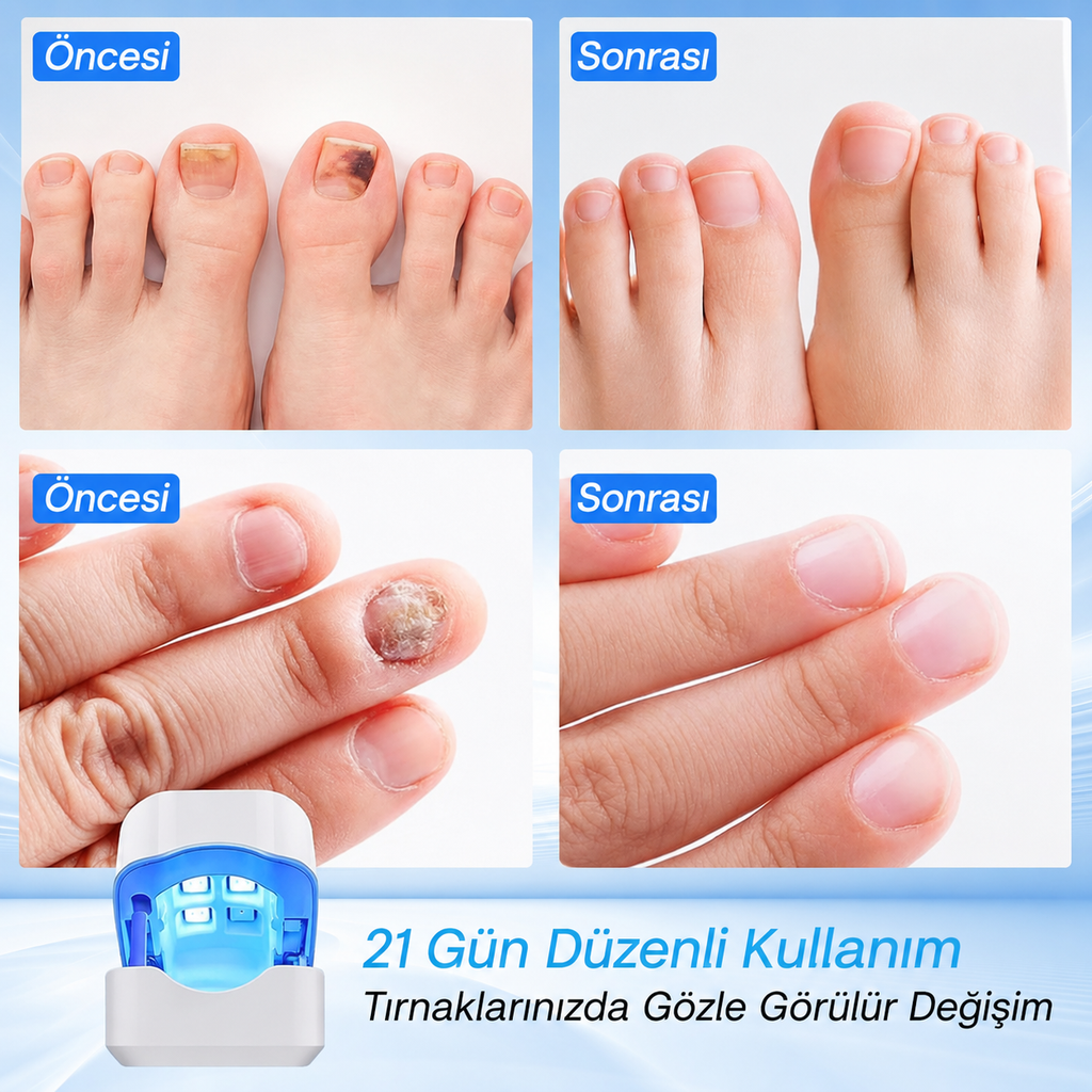 Slumee™ Tırnak Mantarı Tedavi Cihazı